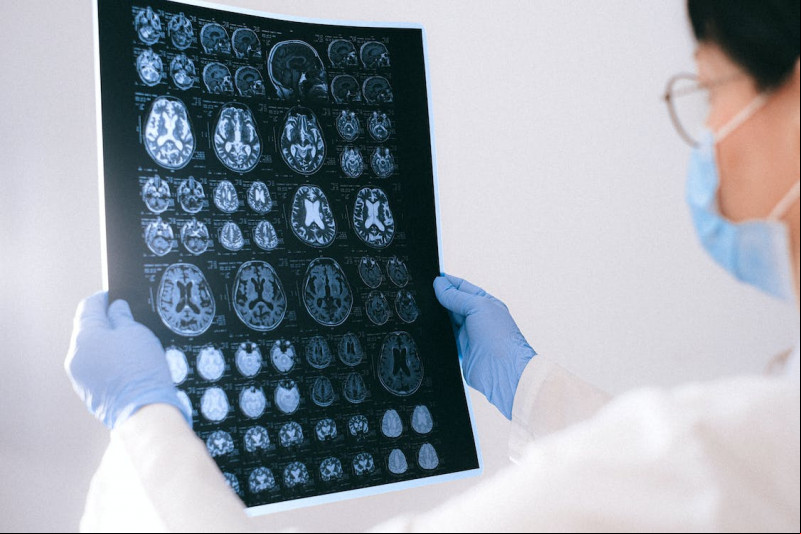 Diagnóstico tardio dificulta tratamento do Alzheimer - (Pexels)