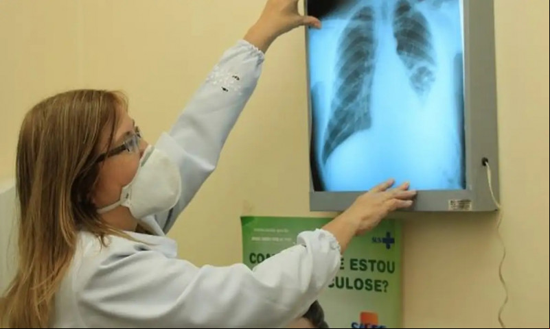 Estudo investiga impactos financeiros da tuberculose no Piauí