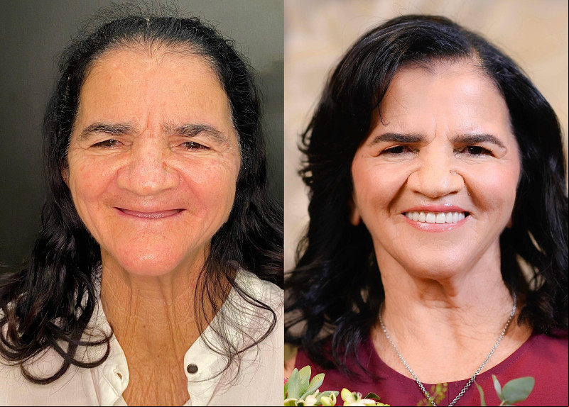 #Transformação - A Drª Jessica Lima - @jessicalimass - protagonizou uma transformação de uma mãe que há muitos anos dedicava atenção e tempo a cuidar da filha e das netas e acabou deixando pra último plano o cuidado consigo mesma, como acontece com muitas mães. Inicialmente, seria um tratamento dentário que terminou com um ensaio de fotos especial assinado pela talentosa @marciabulamarquifotografia. Dona Nativa, que ganhou o novo sorriso, é mãe da dra.mariasilva_. Ela ou pelos cuidados de Bruno Ribeiro do @salaonewconcept , da Thalyta Coelho, que é designer de sobrancelhas @studiothalytacoelho. E ganhou ainda flores da @natuartefloresefestas. Ela ainda ganhou o serviço de coloração pessoal e look de @anasantiagostyling e órios de @dekottjoias. Foi ou não foi uma transformação?! Chics!!! - (Arquivo Pessoal)