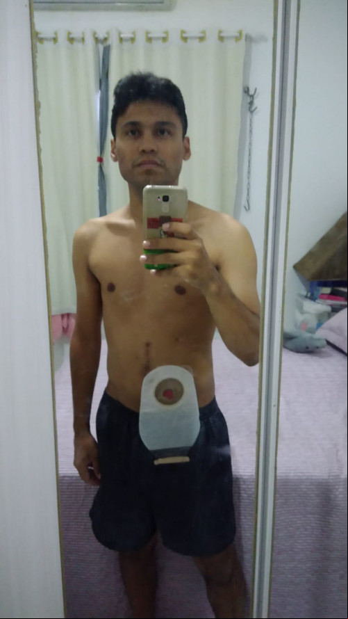 Marcos Vinicius foi diagnosticado com a doença de Crohn há 9 anos - (Arquivo Pessoal)