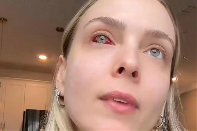 Derrame ocular: vermelhidão nos olhos assusta, mas é inofensiva