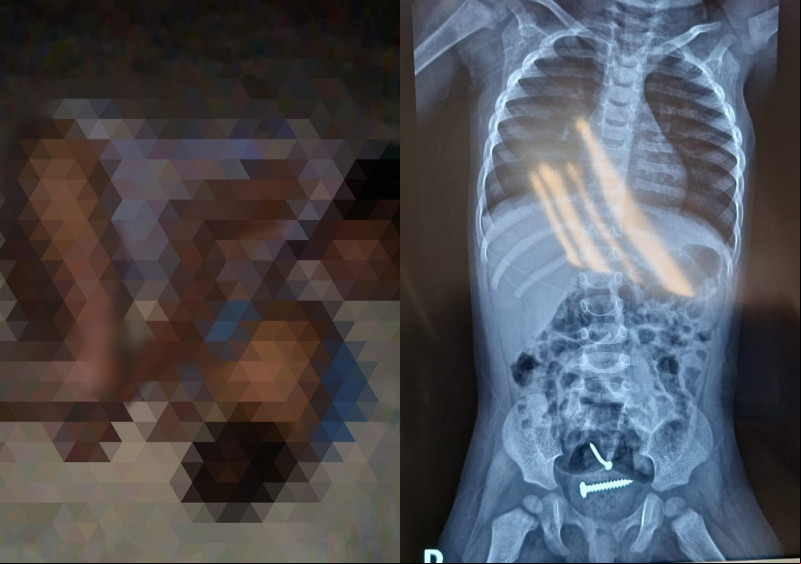 Pregos foram encontrados alojados no abdômen do bebê - (Divulgação / O Dia)